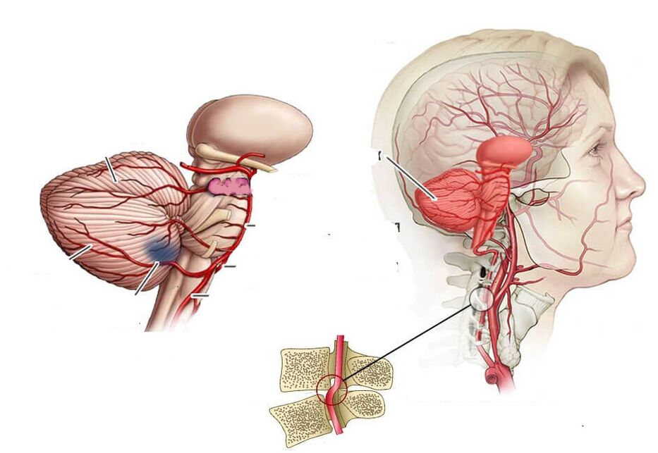 Cerebellar ischemia